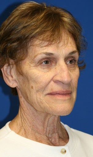 Facelift, Browlift, & Skin Pinch