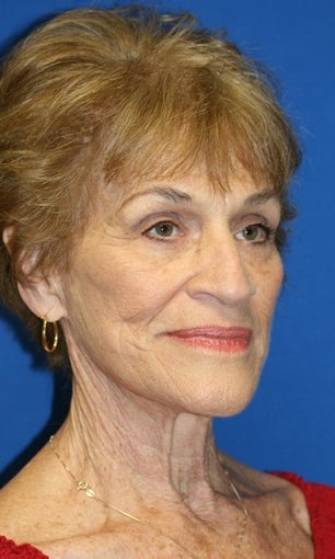 Facelift, Browlift, & Skin Pinch