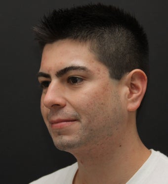 Laser Assisted Lipocontouring of the neck