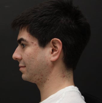Laser Assisted Lipocontouring of the neck