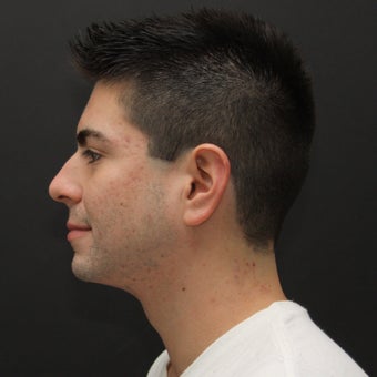 Laser Assisted Lipocontouring of the neck