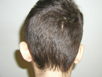 Otoplasty (Ear Correction)