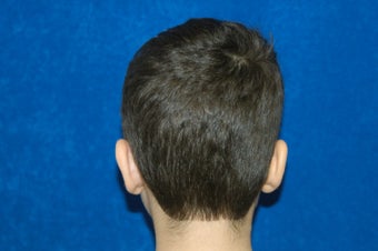 Otoplasty (Ear Correction)