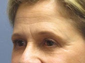 Brow Lift