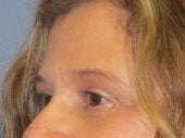 Brow Lift