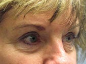 Brow Lift