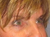 Brow Lift