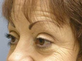Brow Lift