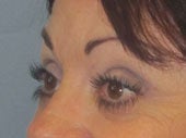 Brow Lift