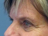 Brow Lift