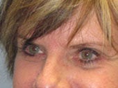 Brow Lift