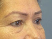 Brow Lift