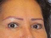 Brow Lift