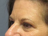 Brow Lift