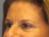 Brow Lift
