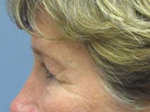 Brow Lift