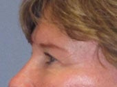 Brow Lift