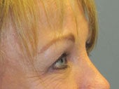 Brow Lift