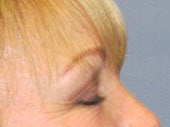 Brow Lift