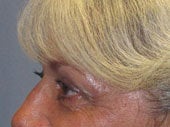 Brow Lift