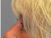 Brow Lift