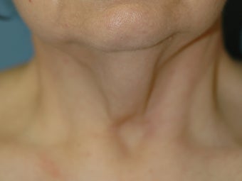 Neck Lift