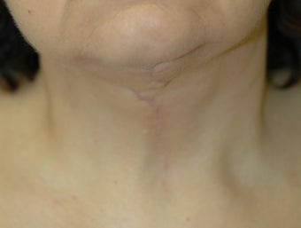 Neck Lift