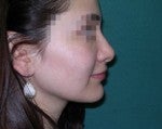 Rhinoplasty