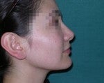 Rhinoplasty