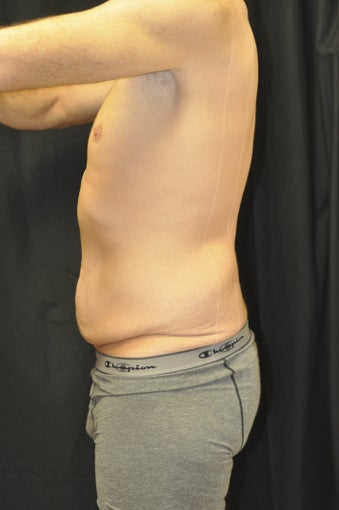 Body Lift