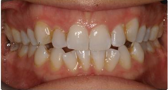 Orthodontic treatment without extraction of teeth