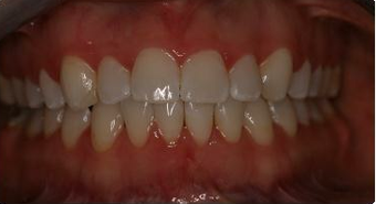 Orthodontic treatment without extraction of teeth