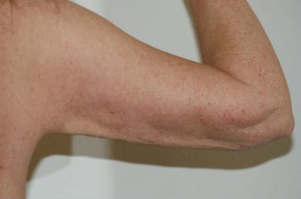 Arm lift (brachioplasty)