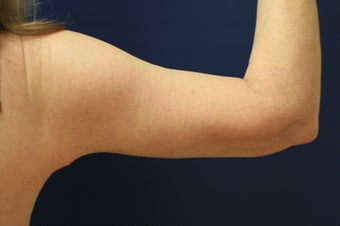 Arm lift (brachioplasty)