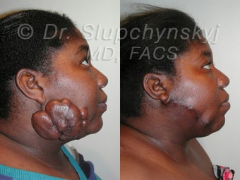 Keloid Removal