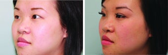 Double Eyelid Surgery Suture