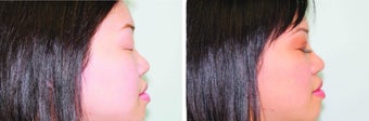 Double Eyelid Surgery Suture