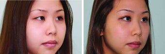 Double eyelid surgery suture