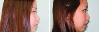 Double eyelid surgery suture
