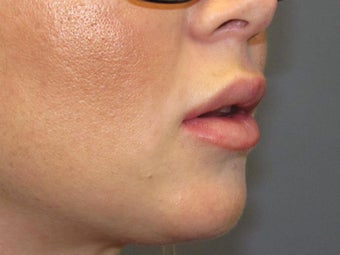 Fat Transfer 