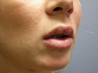 Fat Transfer 