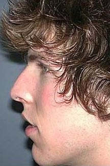 Nose Surgery, Rhinoplasty