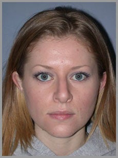 Nose Surgery, Rhinoplasty
