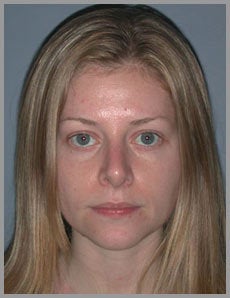 Nose Surgery, Rhinoplasty