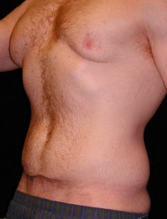 Male Tummy Tuck, Flank Liposuction, Male Breast Reduction