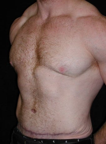 Male Tummy Tuck, Flank Liposuction, Male Breast Reduction