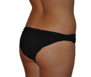 Butt Augmentation (Implants)