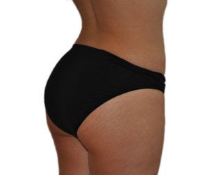 Butt Augmentation (Implants)