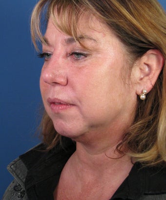 Chin Implant