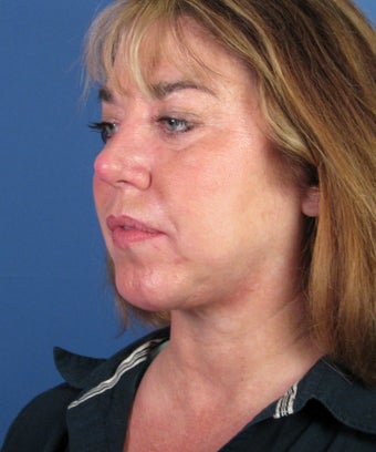 Chin Implant